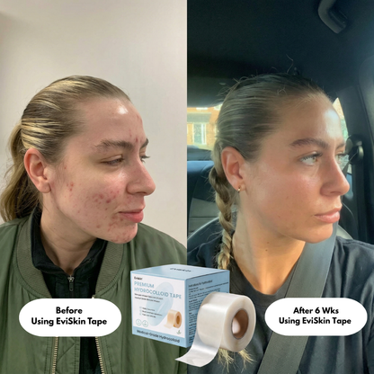 Premium Hydrocolloid Roll That Heals & Protects Your Skin