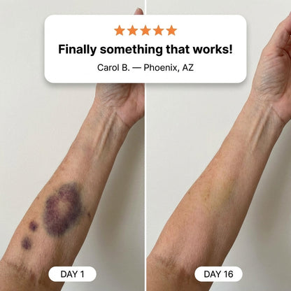 💥100K+ SOLD💕- VELNORS® Bruise Repair & Skin-Strengthening Cream